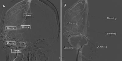 Intracranial Venous Pressures Manometry for Patients With Idiopathic Intracranial Hypertension: Under Awake Setting or General Anesthesia